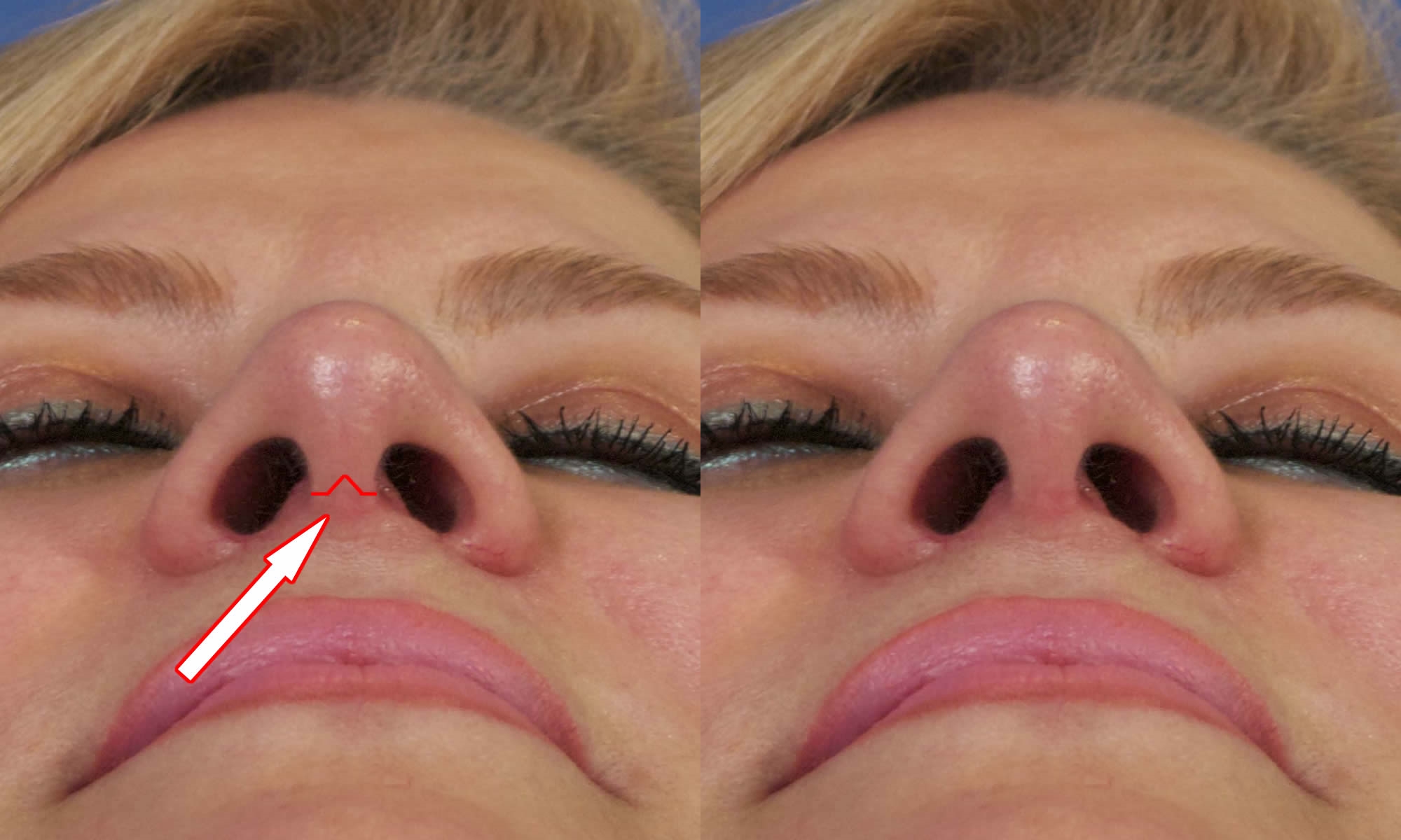 cosmetic eye surgery