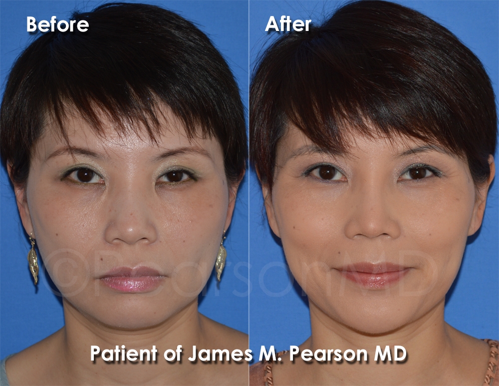 cosmetic eye surgery