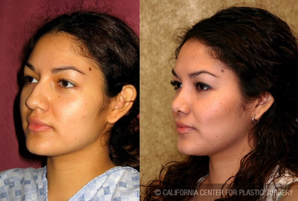 closed rhinoplasty cost